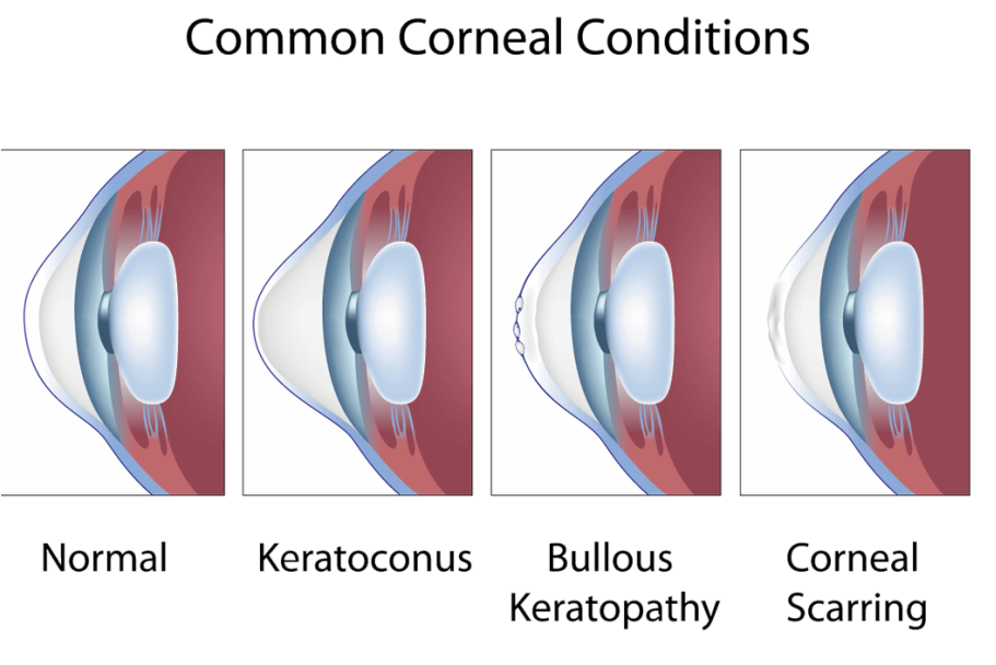 cornea